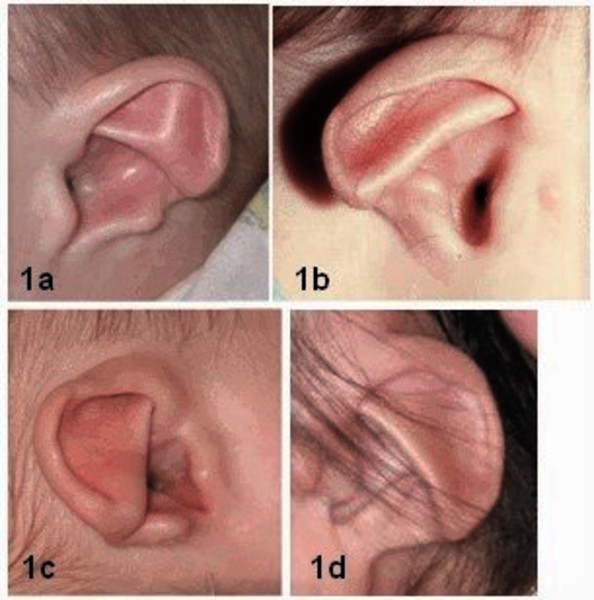 Những bất thường của hệ thống thính giác